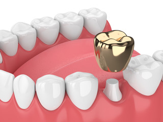 3d render of jaw with dental golden crown filling