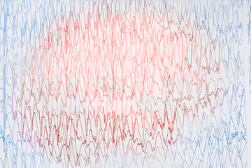 Abnormal EEG  brain wave