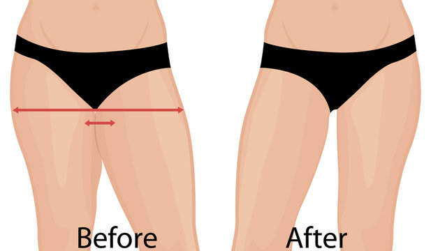 Fat thigs correction.  Liposuction. Before and after. Woman body correction vector illustration