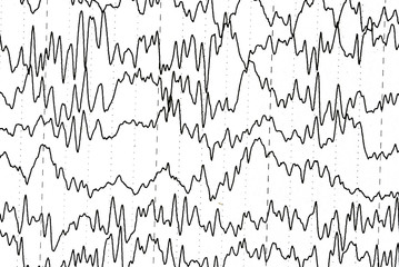 Brain wave patterns on electroencephalogram, EEG of the pediatric patients, problems in the electrical activity of the brain.