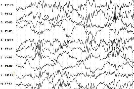 Brain wave patterns on electroencephalogram, EEG of the pediatric patients, problems in the electrical activity of the brain.