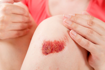 a wound on the knee of a woman closeup