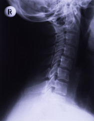 X-ray of neck