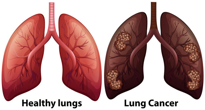 Human Anatomy of Lung Condition