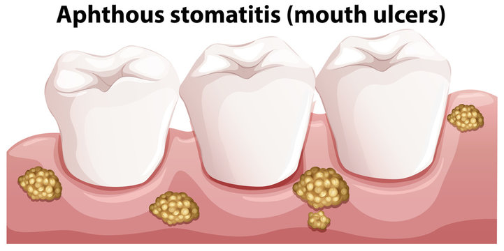 Human Anatomy Of Aphthous Stomatitis