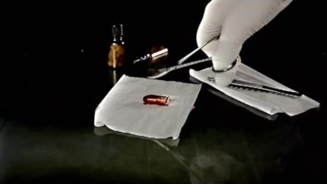Analog capture (intentional heavy distortion fx): the hands of a surgeon removing a bullet from a human body and taking a bottle of pills.
