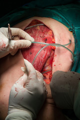 Breast cancer surgery in operating room