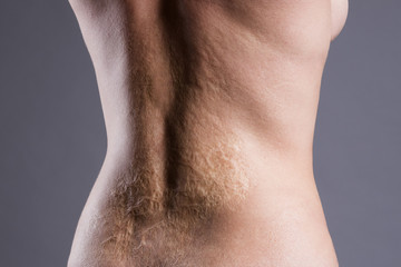 Woman with a large scar after burn on the back