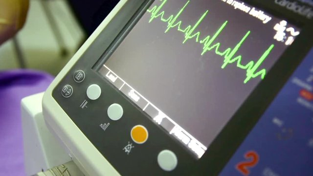 wave in EKG monitor normal sinus rhythm in hospital 