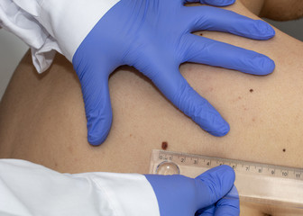 dermatologo estudiando las manchas cafe con leche típicas de la neurofibromatosis