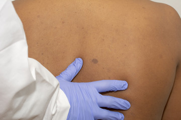 dermatologo estudiando las manchas cafe con leche típicas de la neurofibromatosis