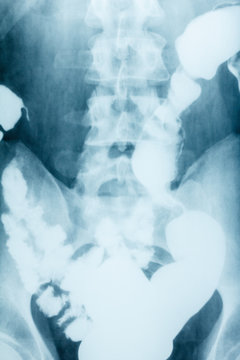 X-ray image plain abdomen , colon