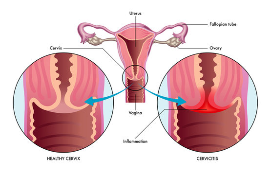 vector medical illustration of the condition cervicitis showing healthy cervix versus one with inflammation