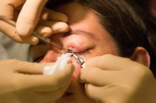 Healthcare concept - Chalazion during eye examination and operation