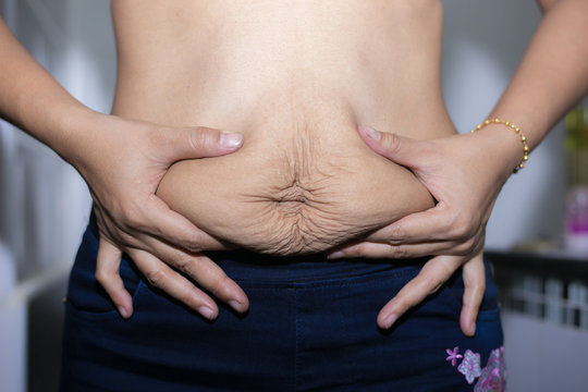 A woman with some overweight, stretch marks on belly closeup