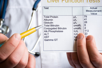 Analysis of bilirubin concept photo. Doctor holding laboratory test of liver function and indicates ballpoint pen on rate of total bilirubin. Raising or lowering level as indicator of liver disease
