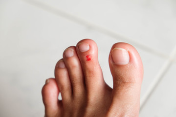 wound on the foot of a woman.