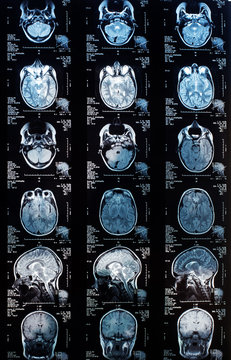 magnetic resonance image (MRI) of the brain