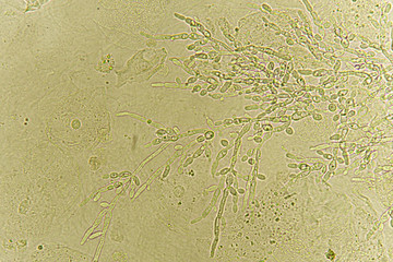 Pseudohyphae and budding yeast cells in patient urine (urinary tract infections), analyze by microscope
