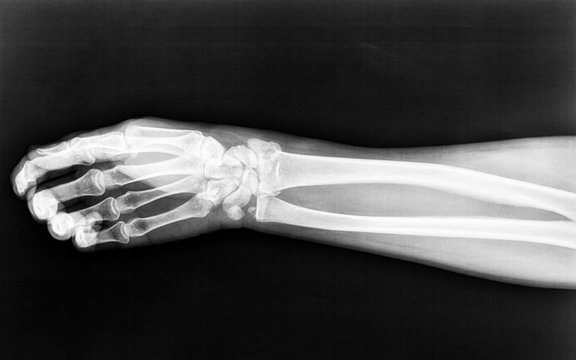 Fractures to the radius born of the right arm on an X-ray