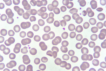 Red blood cells and platelet in blood smear, analyze by microscope