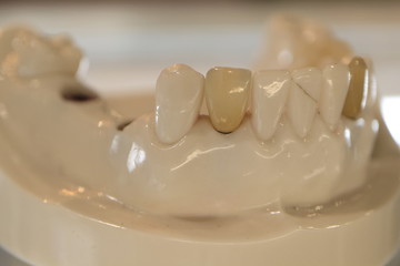 The image of the model of the human jaw and dentures.