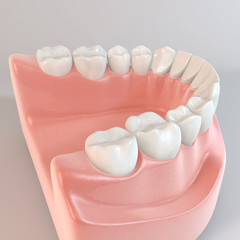 部分入れ歯のCG