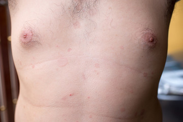 Fototapeta premium Ringworm on the body