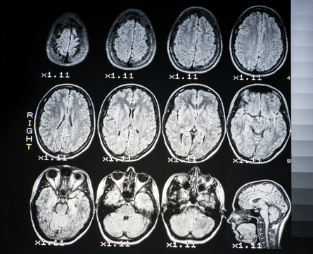 .The result of MRI of the brain of a healthy person with a gray backlight. The longitudinal section of the brain. .