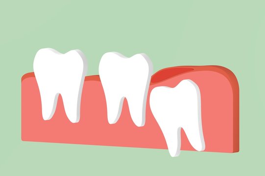 wisdom tooth ( angular or mesial impaction ) with inflammation affect to other teeth
