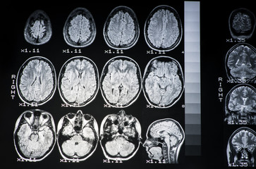 The result of MRI of the brain of a healthy person with a gray backlight. The longitudinal section of the brain. .