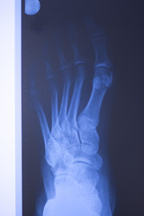 Medical xray foot scan