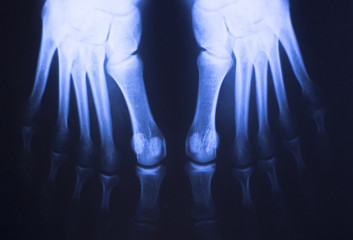 Medical xray foot scan