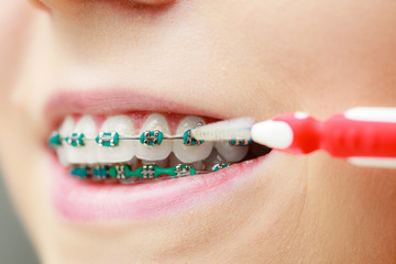 Woman with teeth braces using interdental brush