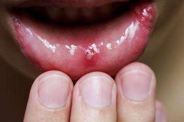 Painful mouth ulcerr of woman's mouth