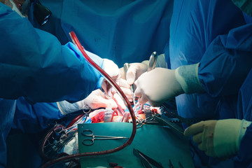 Close up of open heart surgery cardiopulmonary bypass, minimal invasive cardiac surgery,...