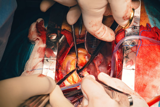 Dissection forceps or hemostatic forceps passing in surgeon hand by team surgeons in surgery center for interventions with instruments in surgeon operation electrosurgery with thoracotomy microsurgery