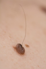 Inborn mole close up. Macro shot of benign skin lesion. Proliferation of pigment derma cells, melanocytic pigmented naevus, naevocytic nevus.