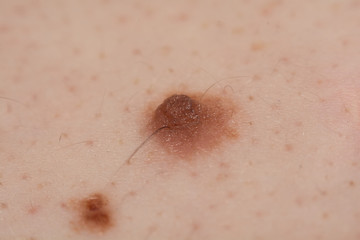 Inborn mole close up. Macro shot of benign skin lesion. Proliferation of pigment derma cells, melanocytic pigmented naevus, naevocytic nevus.