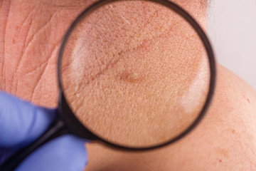 the doctor examines the birthmarks on the man's body
