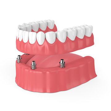 3d Render Of Removable Full Implant Denture