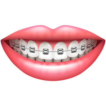 Teeth with braces woman smile isolated on white vector
