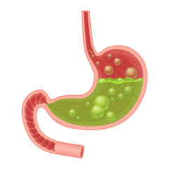 Fototapeta premium Realistic medical illustration of nausea stomach isolated. Green liquid inside stomach.