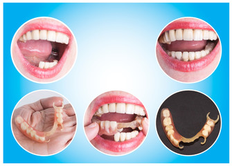 Dental rehabilitation with upper and lower prosthesis, before and after treatment