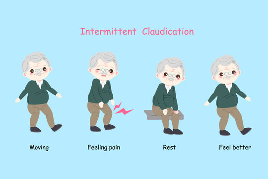 man with intermittent claudication