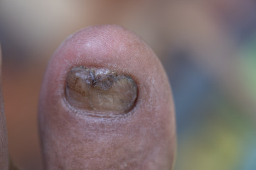 Bare feet of impoverished man resting.