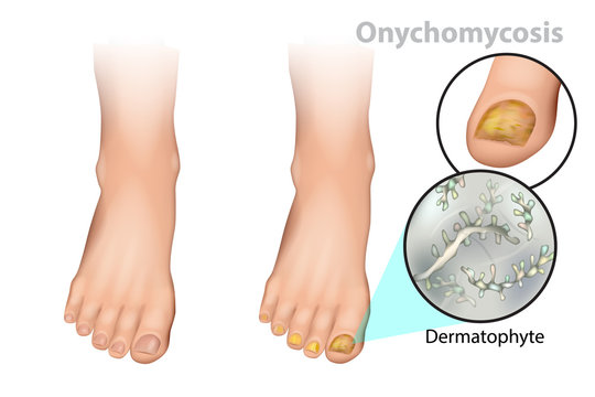 Onychomycosis or tinea unguium. Fungal nail infection