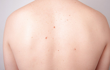 Naklejka premium Dermatologist examining birthmark of patient, closeup. Cancer concept.