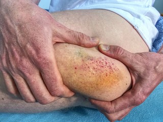Hand embracing injured leg with painful hematoma