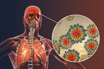 Measles induced complications, conceptual image. 3D illustration showing pneumonia and encephalitis with close-up view of measles viruses - obrazy, fototapety, plakaty